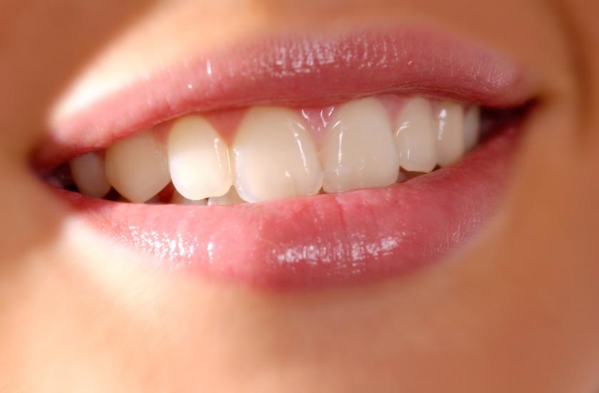 Bọc răng sứ kim loại có mấy loại?