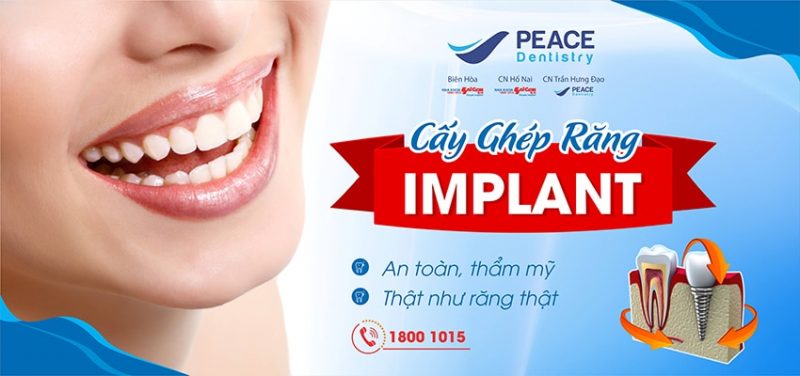 cay_ghep_implant_tham_my