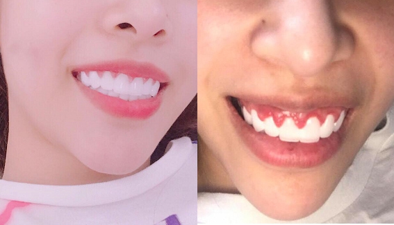 bọc răng sứ 2 hàm
