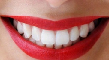 trồng răng cửa như thế nào
